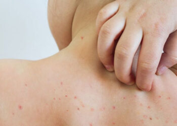 Sarampión: el Colegio de Farmacéuticos llama a no bajar la guardia