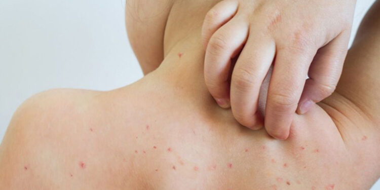 Sarampión: el Colegio de Farmacéuticos llama a no bajar la guardia