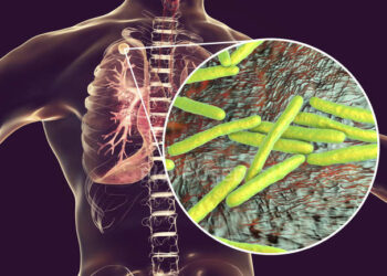 Aumentan los casos de tuberculosis en Santa Fe: la importancia de la prevención y el diagnóstico temprano