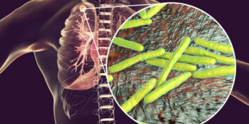 Aumentan los casos de tuberculosis en Santa Fe: la importancia de la prevención y el diagnóstico temprano