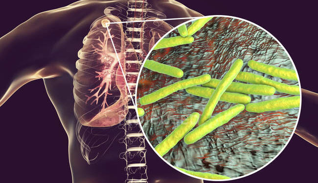 Aumentan los casos de tuberculosis en Santa Fe: la importancia de la prevención y el diagnóstico temprano