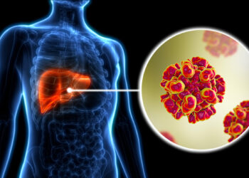 Hepatitis: qué es, cómo se transmite y cómo se trata