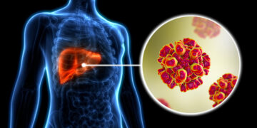 Hepatitis: qué es, cómo se transmite y cómo se trata